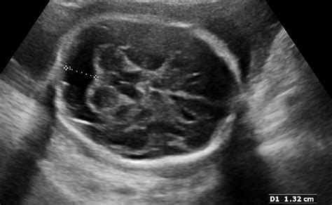 arachnoid cyst vs mega cisterna magna|cisterna magna fetal ultrasound.